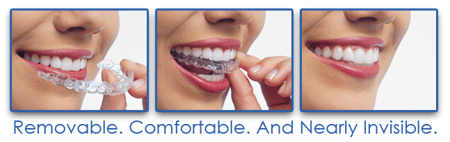 San Jose Invisalign - Clear Invisible Teeth Braces San Jose, CA