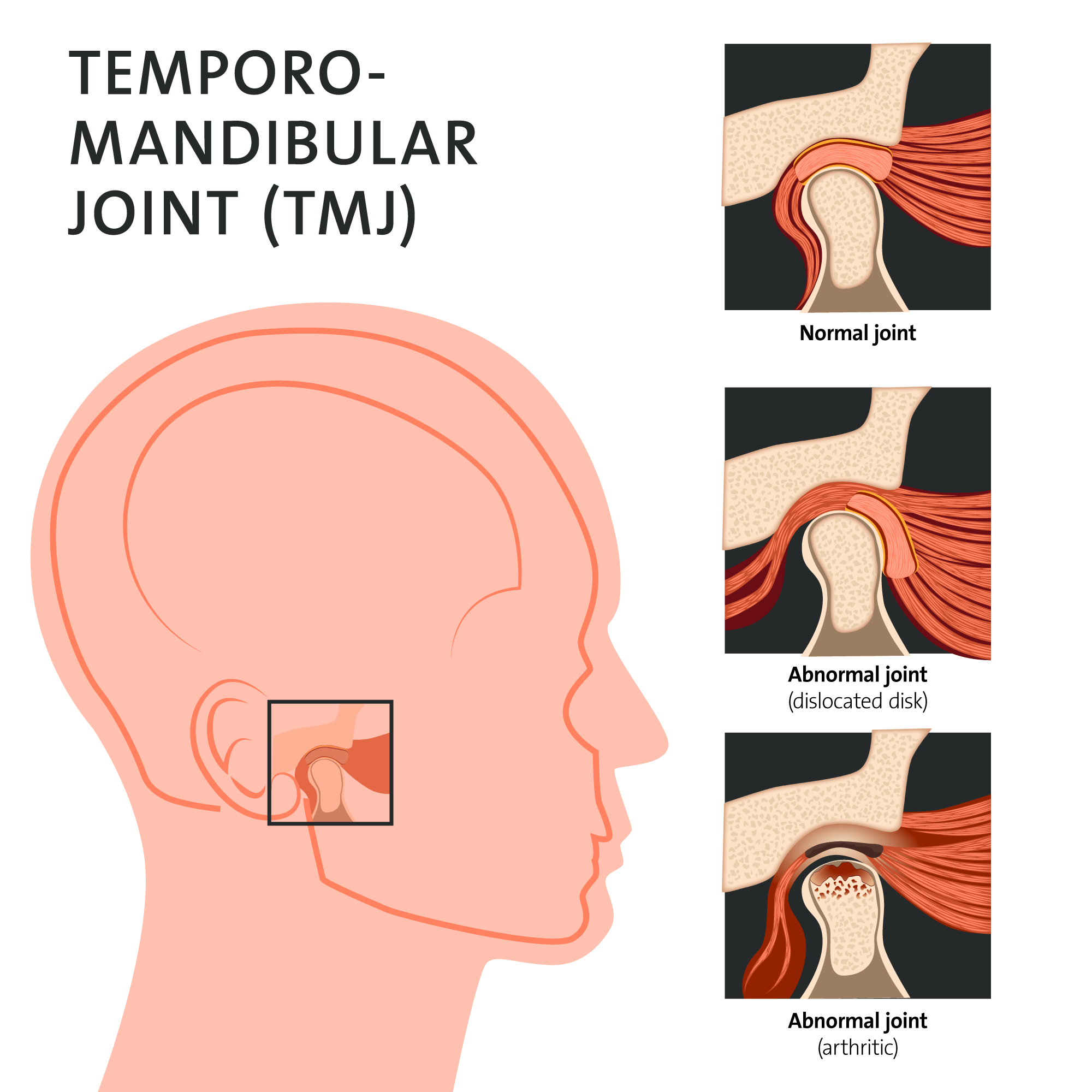 tmj joint temporomandibular tmd disorder pain treatment anatomy syndrome dysfunction relief diagram dental clearcorrect support